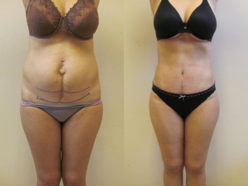 Abdominoplasty: before and after