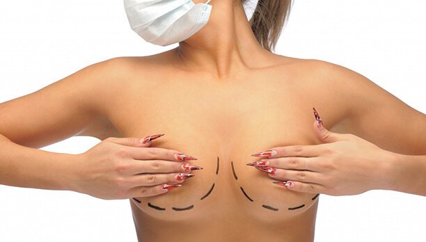 Marking mammoplasty
