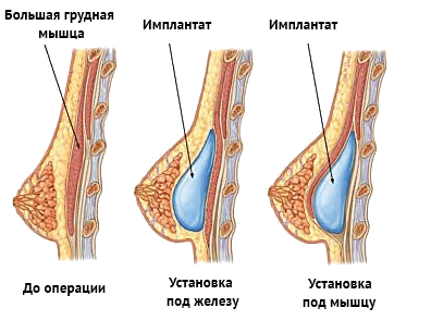 Implant plastics