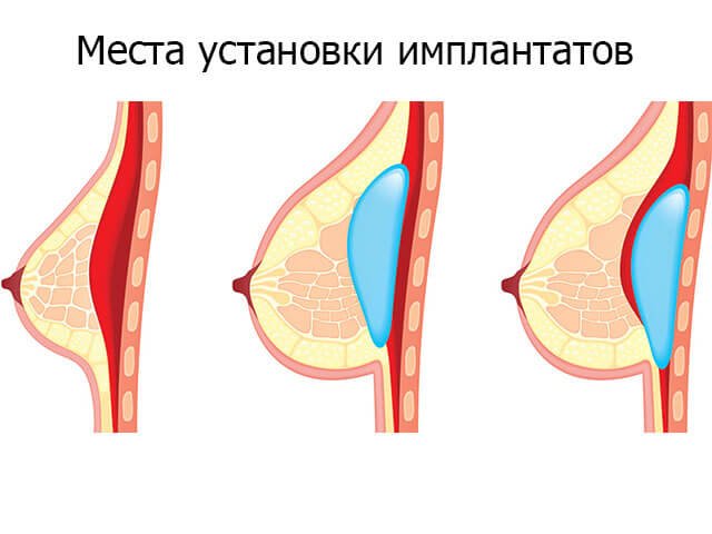 Implant placement sites