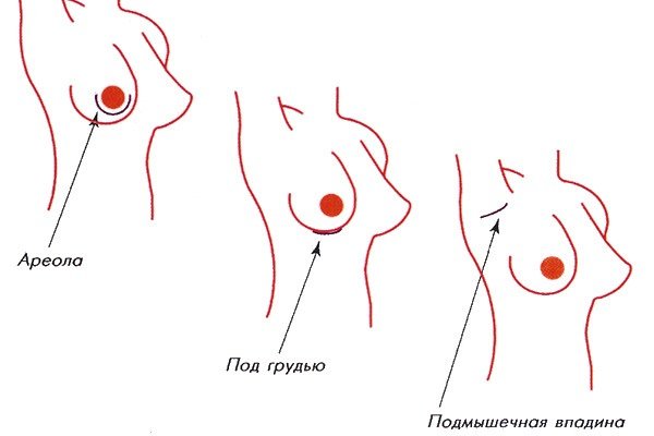 Methods of breast augmentation