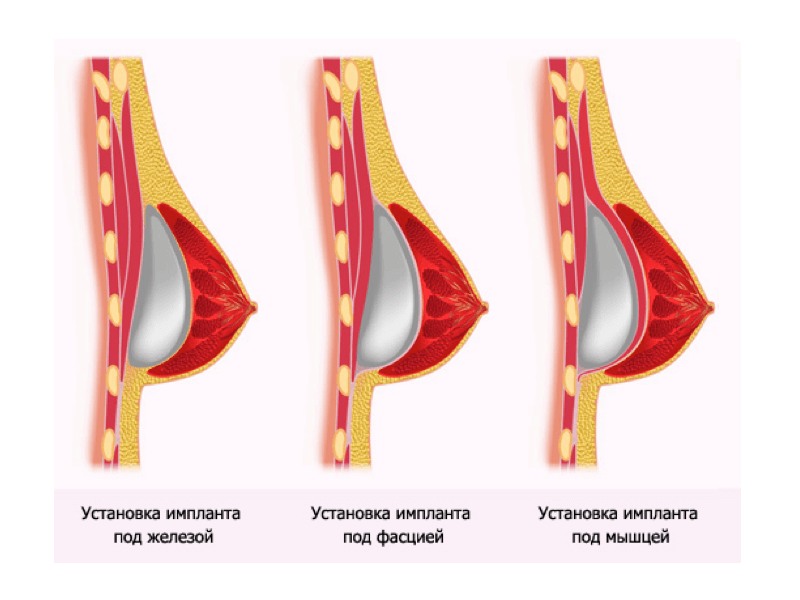 Implant installation methods