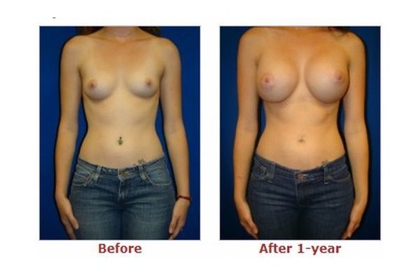 Results of augmentation mammoplasty