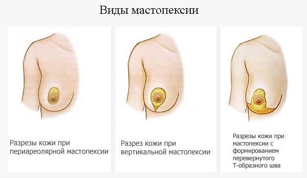 Types of mastopexy