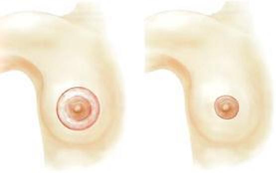 Example of a peri-rectolar breast lift