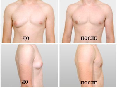 Why spend breast plastic in men