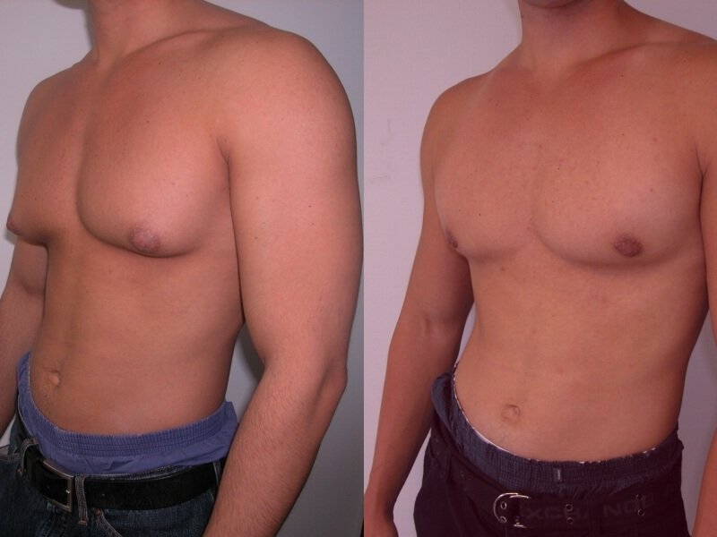 Breast liposuction in men: results