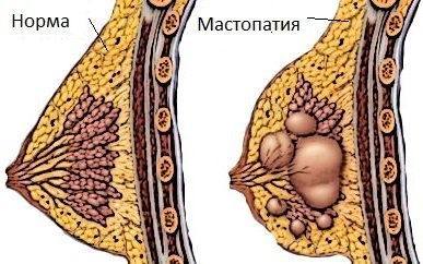 Mastopathy may develop after a breast lift.