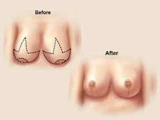 Why do breast reduction surgery?