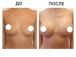 Breast lipolifting: results