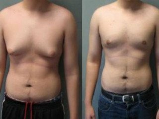 Breast enlargement in men