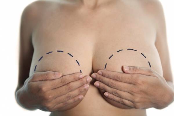 Indications for periareolar mastopexy