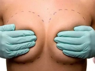 Breast correction