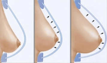 Breast correction