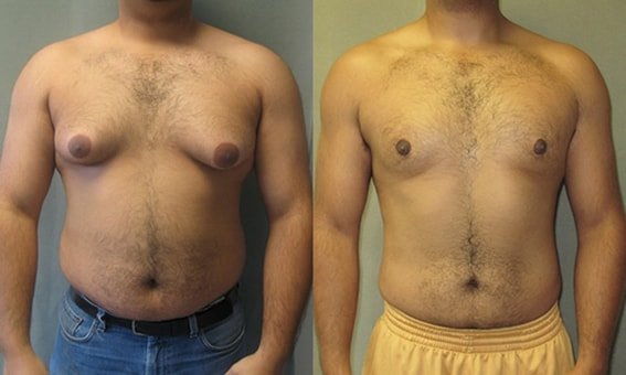 Gynecomastia in men