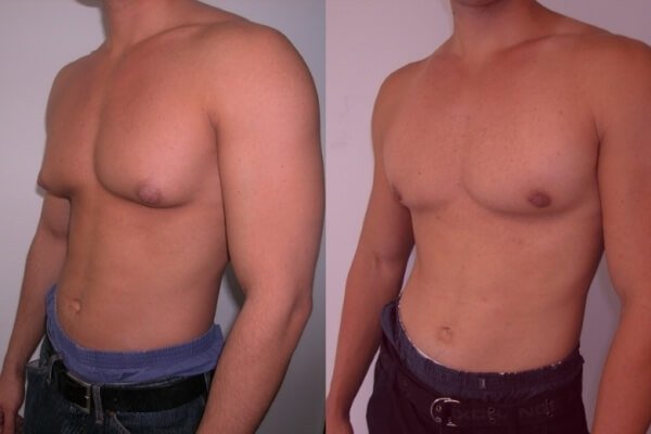 Before and after removal of gynecomastia