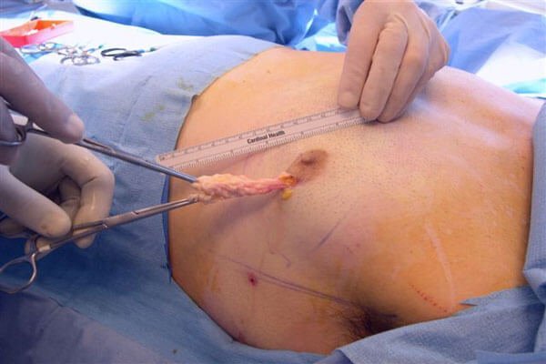 Gynecomastia surgery