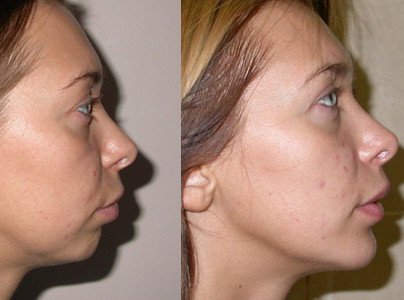 Chin contour correction result