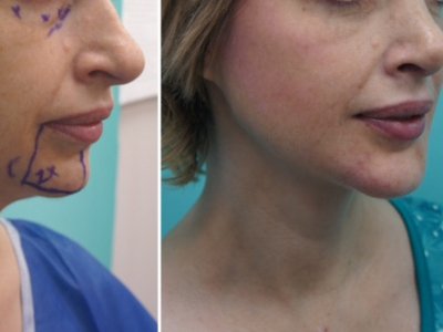 Chin Enlarging Implants