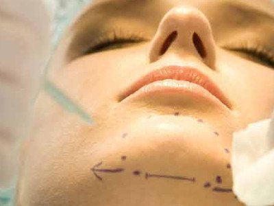 Second Chin Liposuction Results