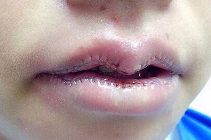 Sewn lips