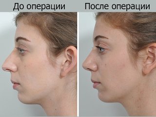 Otoplasty of the ears