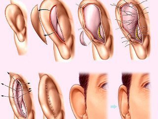 Ear plastic surgery