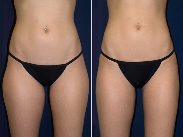 Hip liposuction result