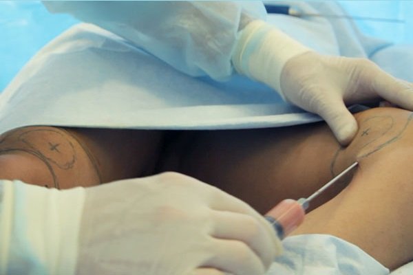 Liposuction of the knees