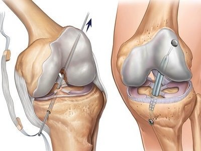 Knee joint surgery