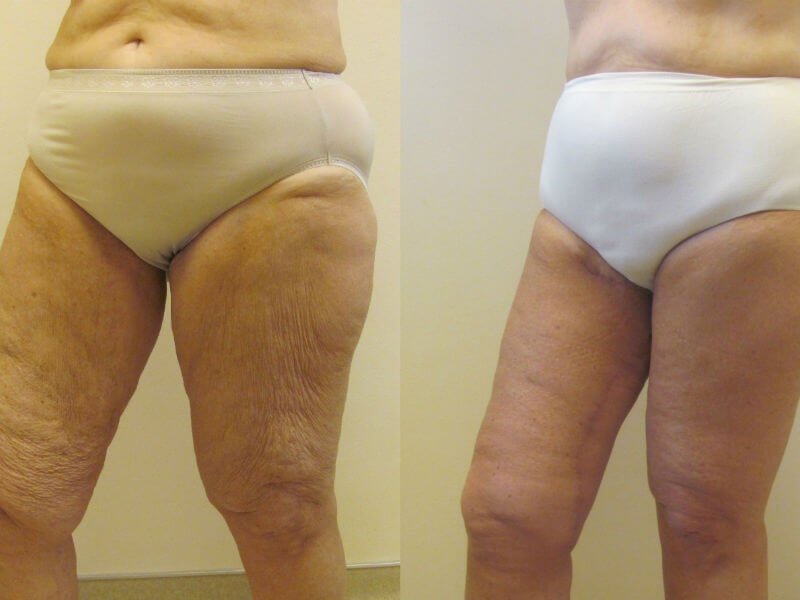 Hip surgery: before and after