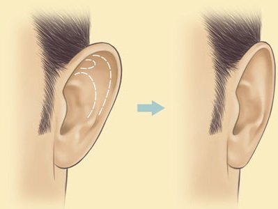 Repeated otoplasty for lop-earedness