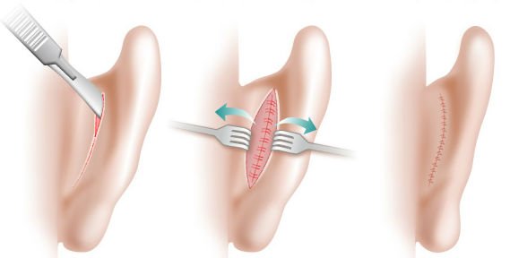 Stitches after otoplasty