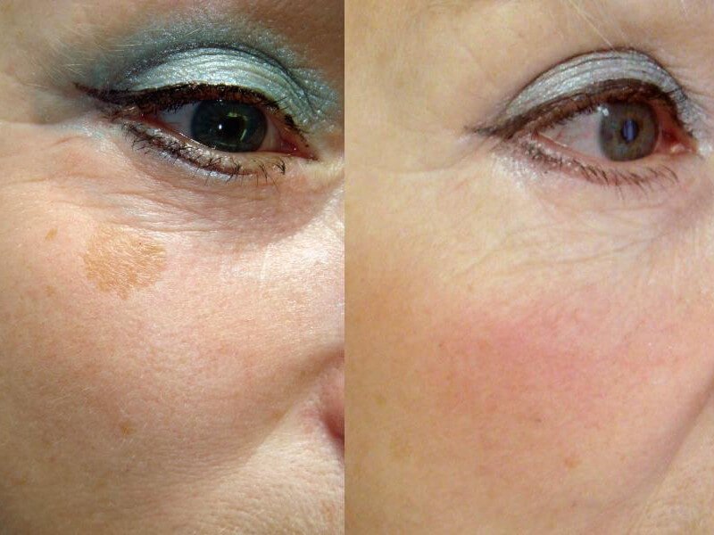 How to remove pigment spots with a laser