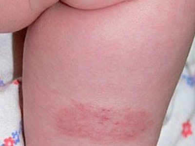 Birthmarks - what to do with them