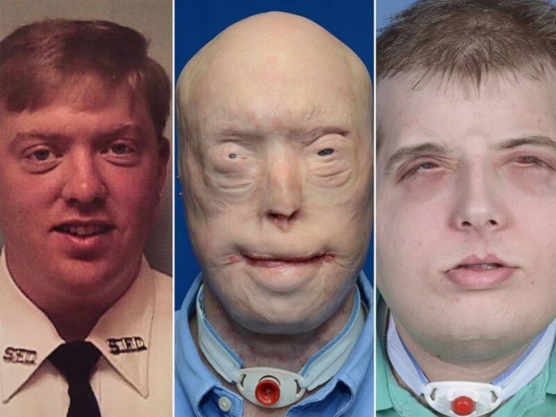 An example of a facial transplant