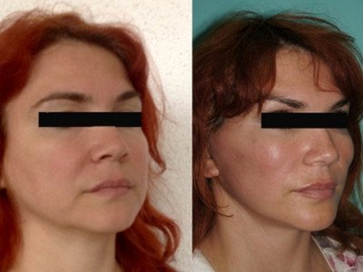 Facial Laser Liposuction Results