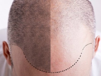 Head hair transplantation