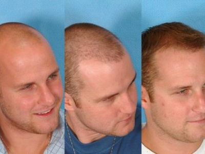 The result of hair transplantation on the head in men