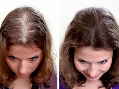 Result hair transplant women