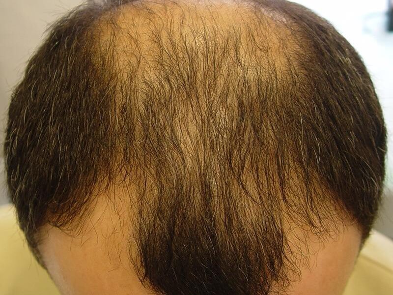 Hair transplantation: indications