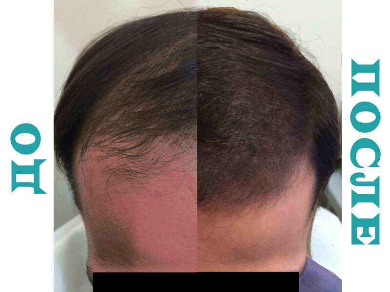 Hair transplantation: the result