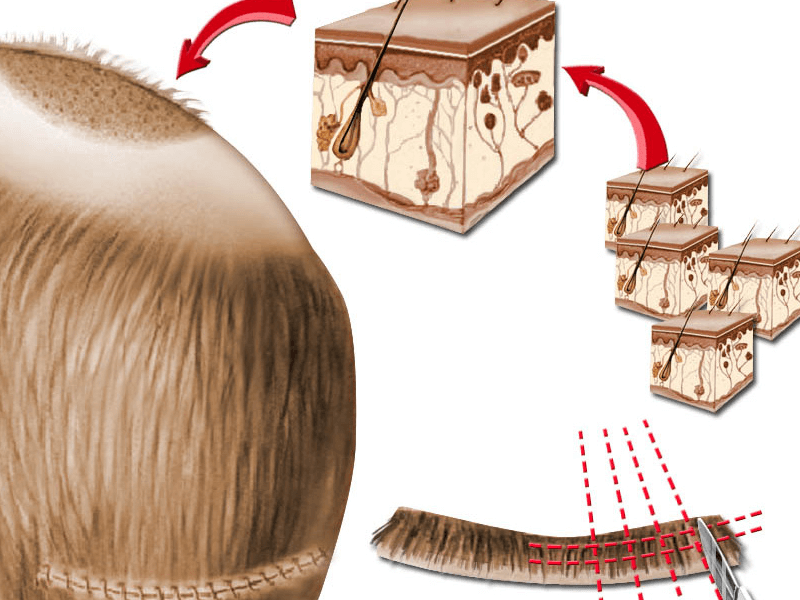 Hair transplant surgery: patchwork method