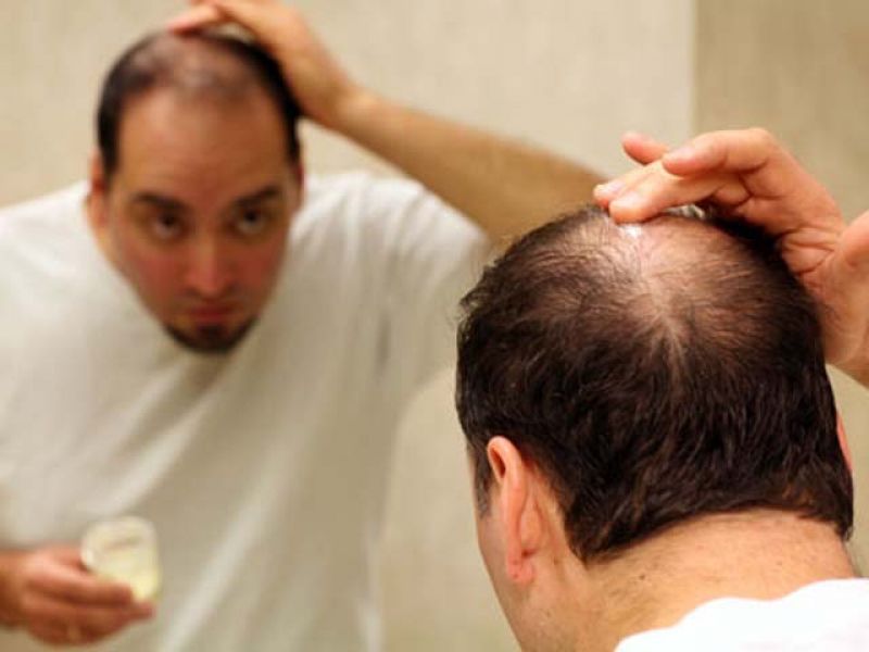 Alopecia Treatment