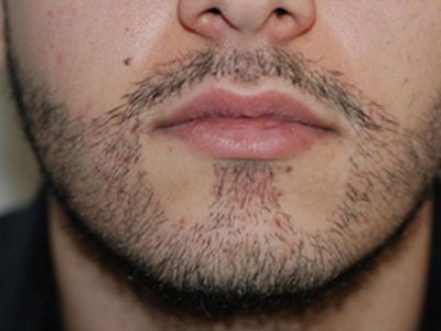 Hair transplant from chest to face