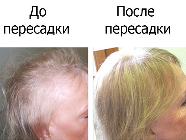 Transplantation of artificial hair Biofibre