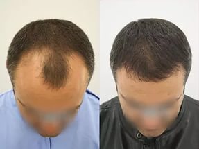 Hair transplant: before and after