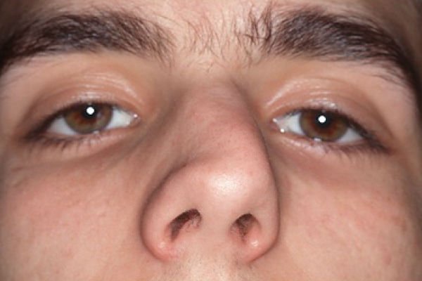 Nasal deformity after rhinoplasty