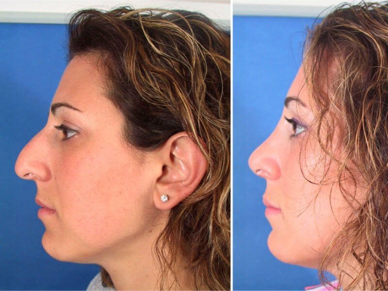 Successful rehabilitation after rhinoplasty