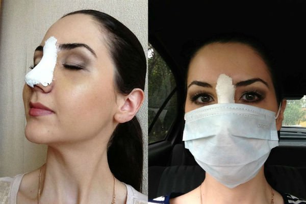 Gradual recovery from rhinoplasty